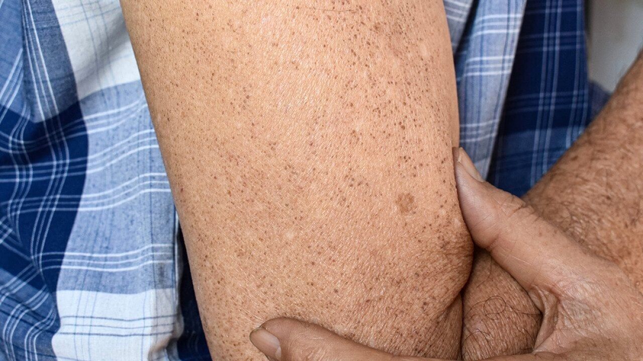 Sunspots vs. freckles: How to tell them apart