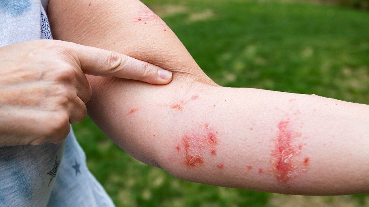6 ways to get rid of poison ivy rash symptoms fast