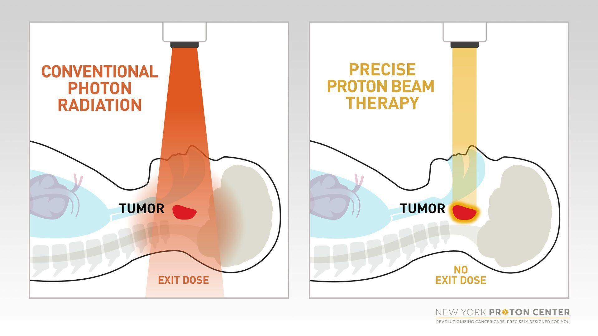 Proton therapy precisely targets tumors while minimizing radiation exposure to surrounding healthy tissues and critical organs. Unlike conventional photon radiation, proton beams can be customized to travel to a specified depth in the body and then stop...