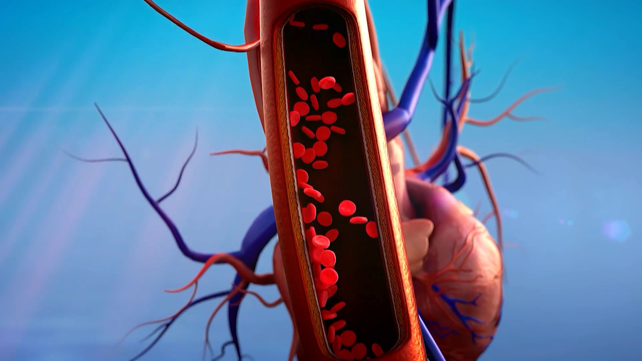 aortic dissection
