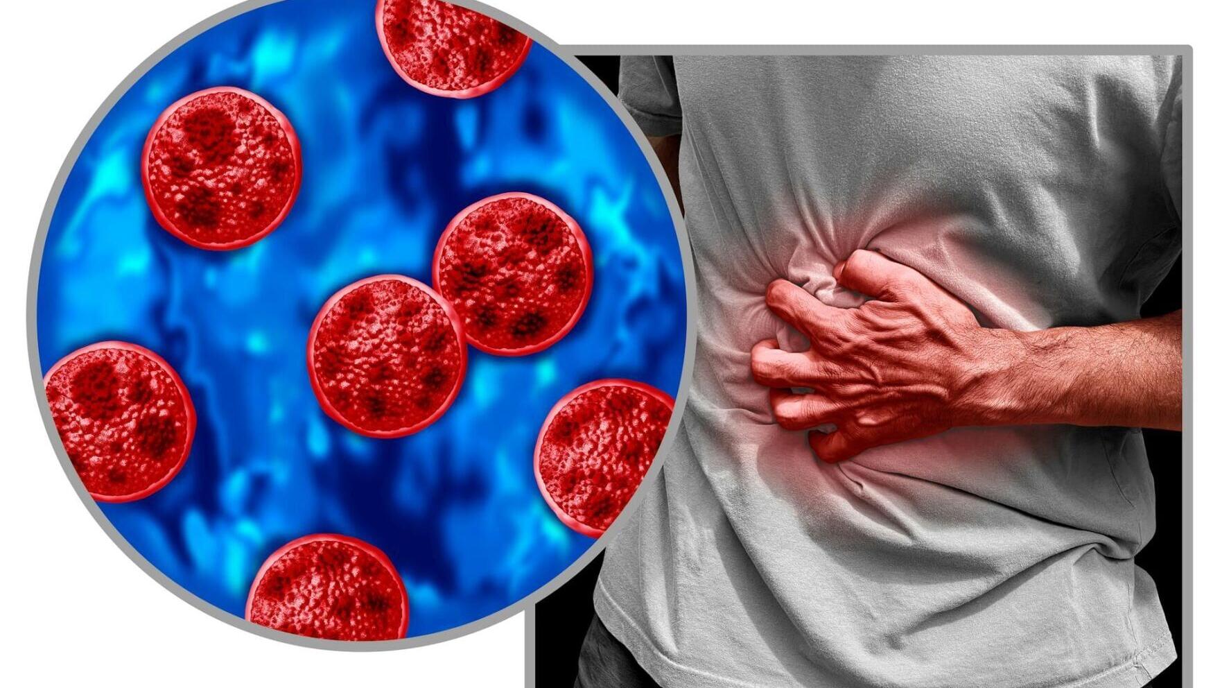 Cyclosporiasis can cause severe gastrointestinal distress, including explosive diarrhea.