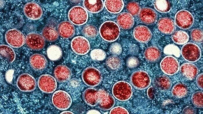 Monkeypox