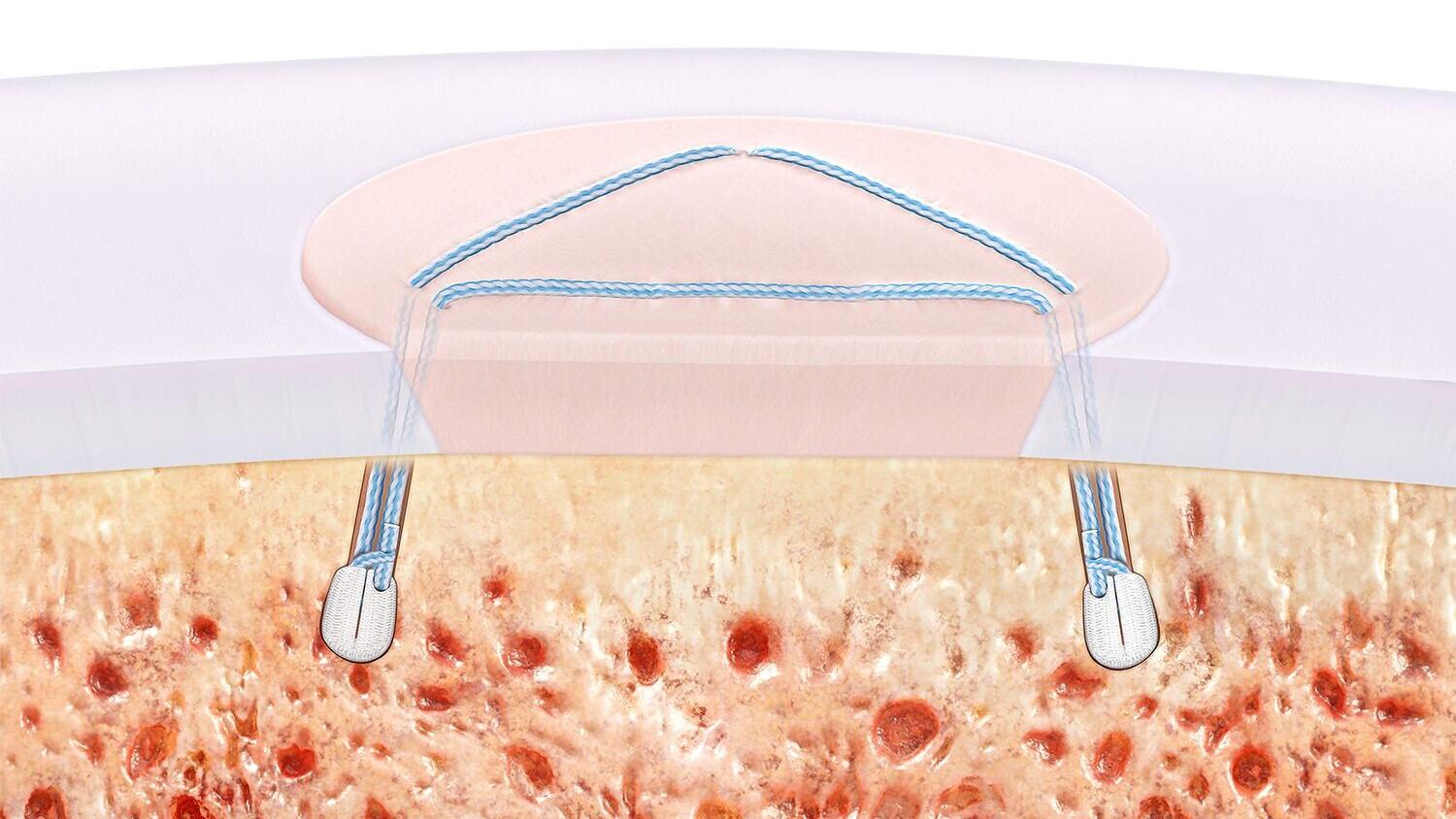 The collaboration with ICRS comes as Arthrex continues to expand its joint preservation portfolio. Recent advancements include the launch of the ChondralTak™ technique, the first new cartilage fixation device to be introduced to the market in 23 years, ...