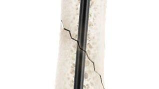Meduloc’s flexible nitinol intramedullary implant positioned within the bone