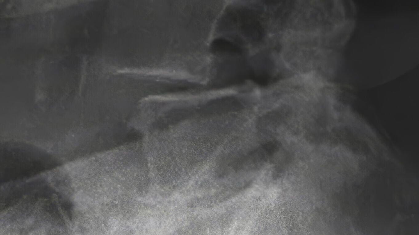 Luna Ti Pre-Op image - Spinal Elements