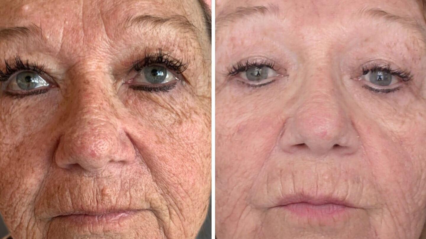 Results courtesy of Jeanette Marie Medical Esthetician in Wyandotte, MI