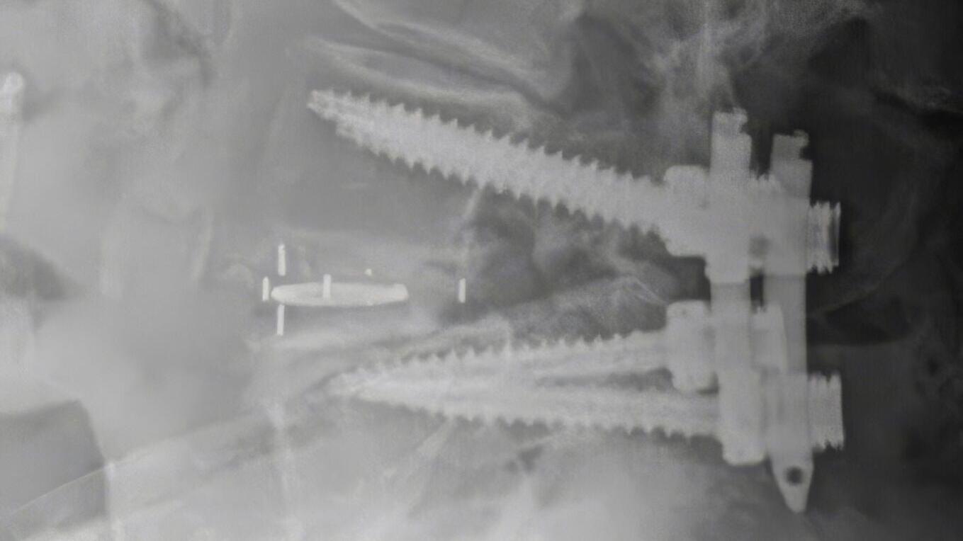 Luna Ti Post-Op image - Spinal Elements