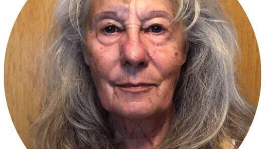 Patient Before Byun Facelift