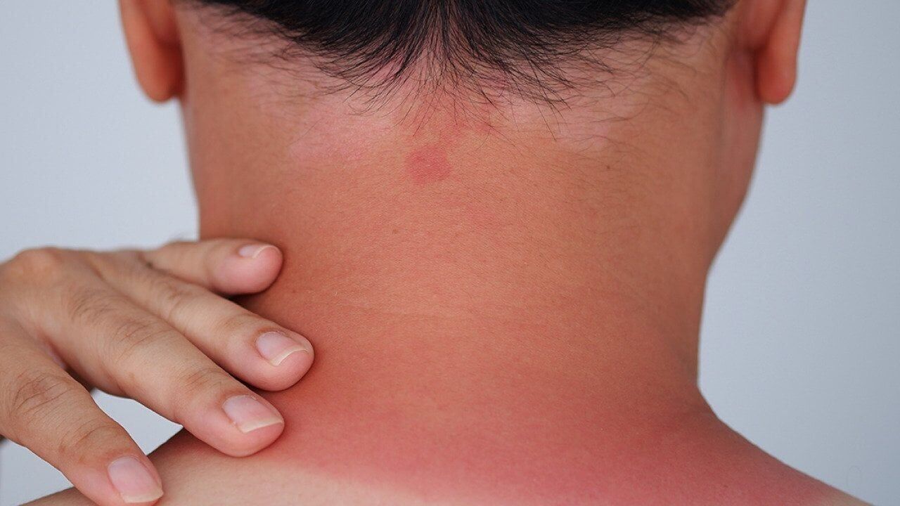Sunburn relief: Dermatologist-approved methods that actually work