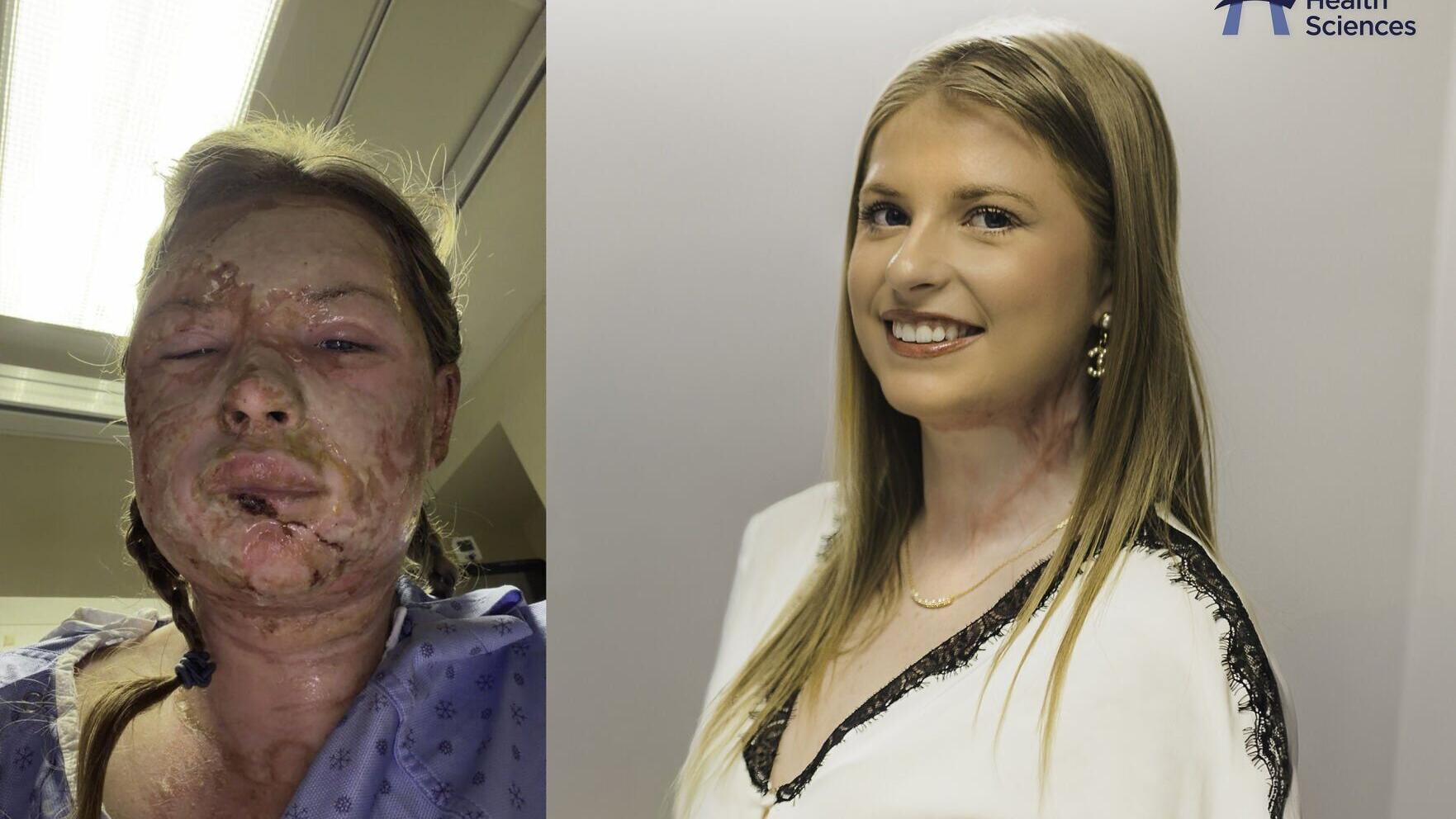 Kaitlin Jeffrey received exosome therapy at Hamilton Health Sciences to treat severe burns to her face – a global first.