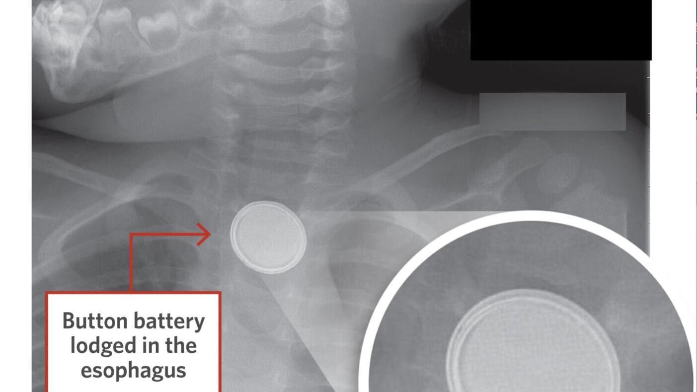 The AAO-HNS urges families to keep all coin-cell and button batteries out of children’s reach, secure battery compartments, and seek emergency care immediately if a battery ingestion is suspected.