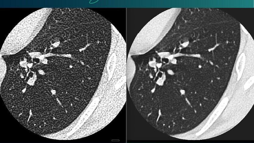 Comparison of lung CT scans showing conventional imaging on the left and SubtleHD(CT)-enhanced imaging on the right.