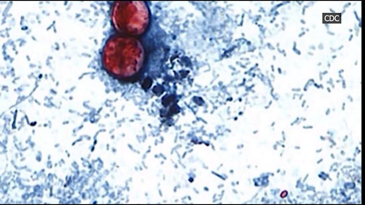 Cyclospora outbreak linked to iceberg lettuce reaches Arkansas