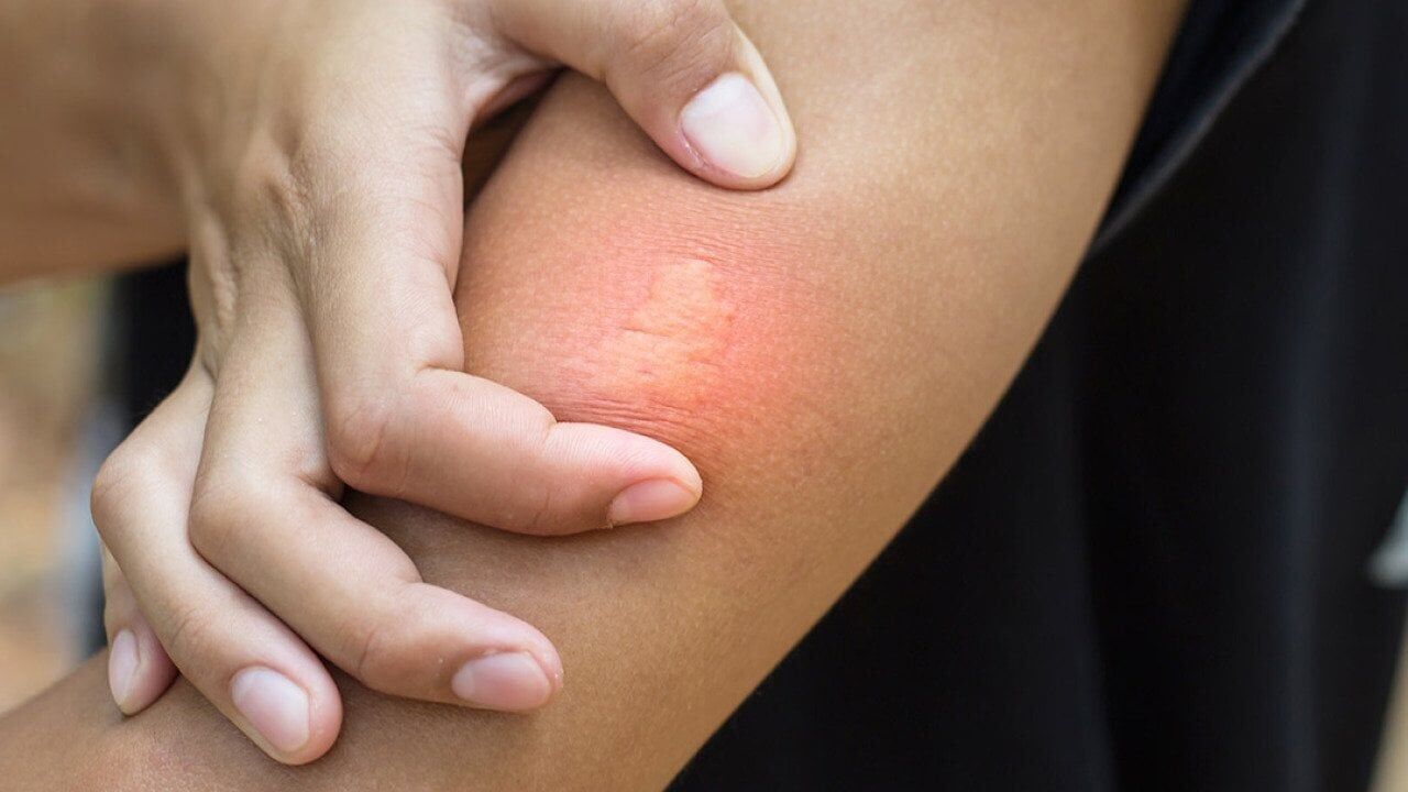 Normal bee sting vs. allergic reaction