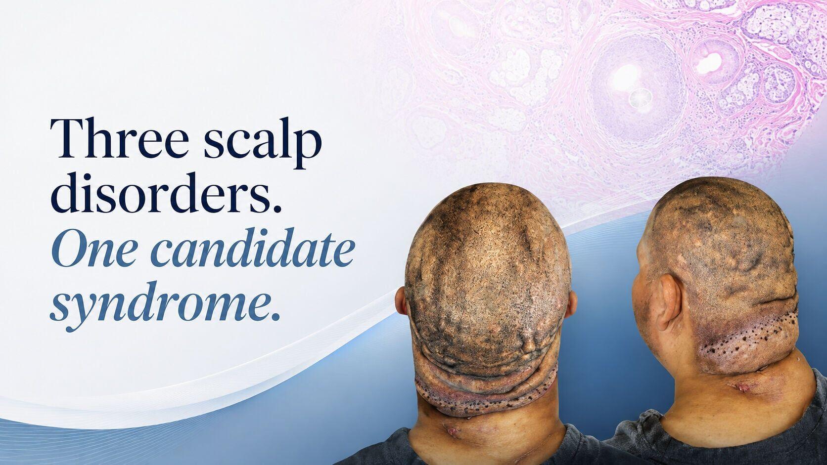 Clinical views and representative histology show the three-part scalp pattern proposed as a candidate syndrome: severe nape scarring from acne keloidalis nuchae, scalp-wide dissecting cellulitis, and deep folds of secondary cutis verticis gyrata