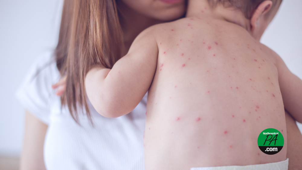 measles ncpa - 1